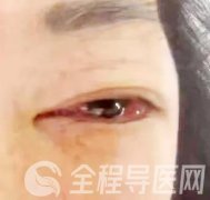 徐州市一院眼科聯(lián)合血管外科成功救治一名罕見頸動脈海綿竇瘺患者